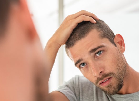consejos para evitar la calvicie